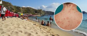Procuraduría exige evaluación urgente tras aparición de brotes en bañistas de playas en Santa Marta
