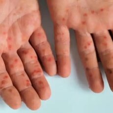 Secretaría de Salud de Barranquilla vigila 2 casos sospechosos de sarampión