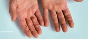 Secretaría de Salud de Barranquilla vigila 2 casos sospechosos de sarampión