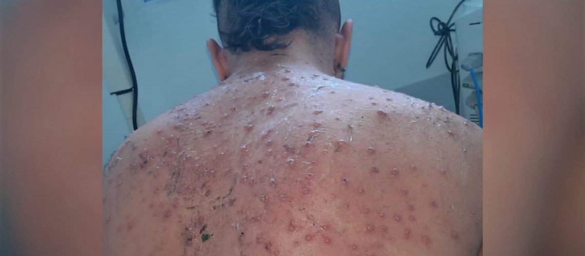 En Barranquilla no hay viruela símica