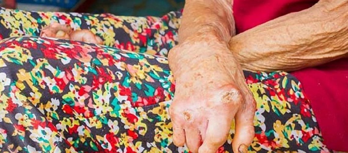 Enfermedad lepra referencia (1)