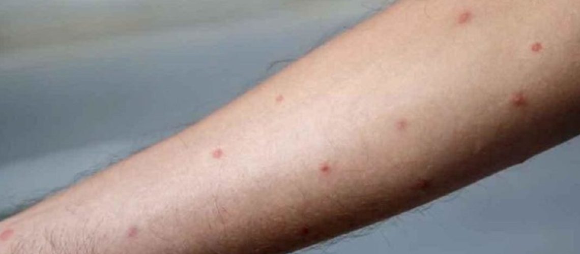 Viruela del mono (10)