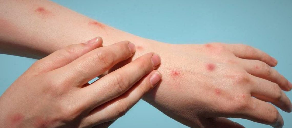 Viruela del mono (9)