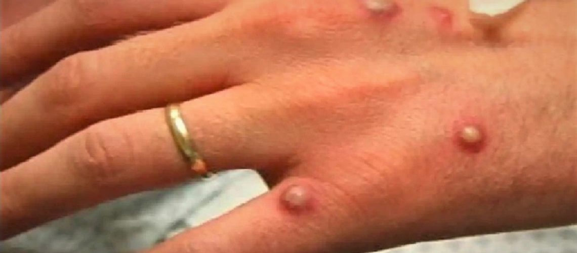 Viruela del mono DESTACADA FOTO